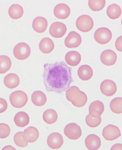 What causes high blood platelets?
