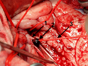 Fogarty catheter removing thrombus from aorta