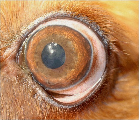 Corneal Arcus Senilis Treatment · Top Eye Doctor · Ophthalmologist NYC