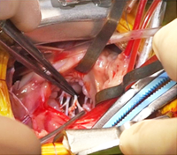 Chordae Tendineae