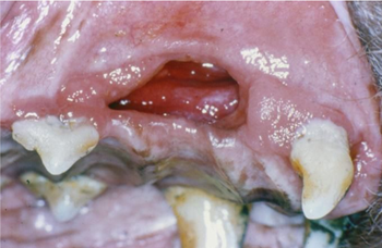 Oronasal Fistula