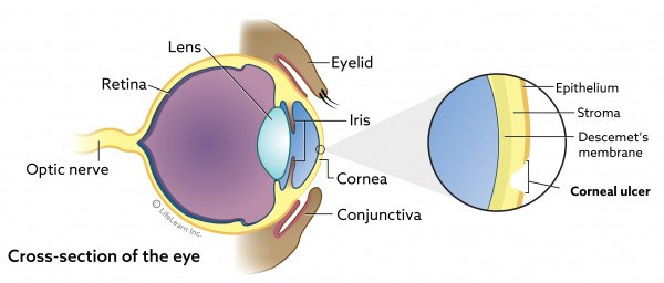 Eye Diagram of Corneal Ulcer