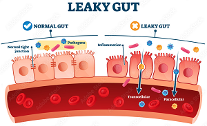 Leaky Gut Syndrome